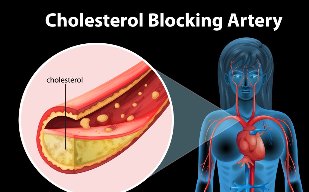 LDL Cholesterol